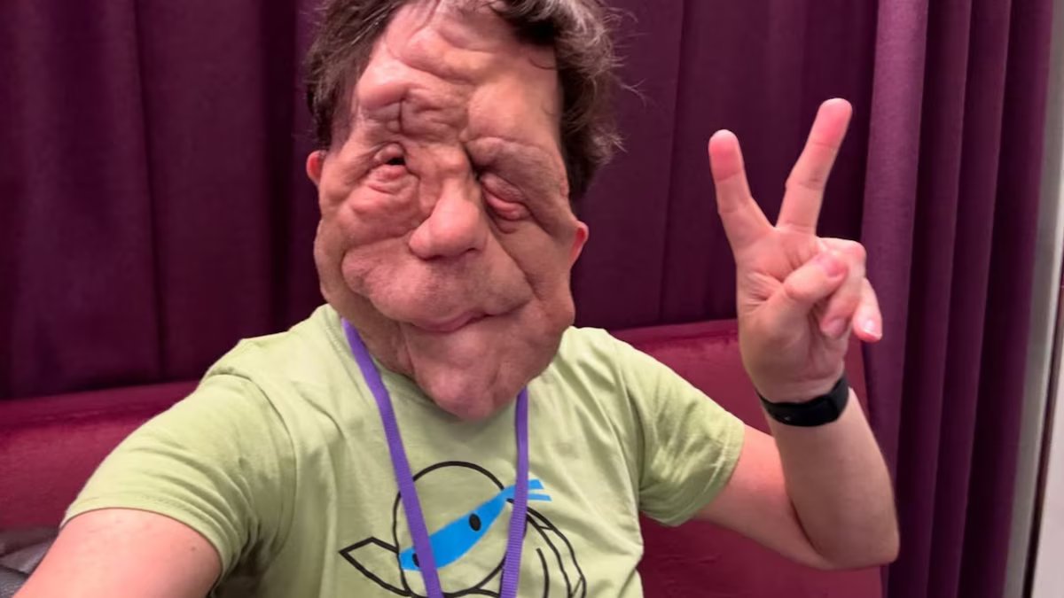 O que é e como se trata a neurofibromatose, doença que o ator Adam Pearson tem?