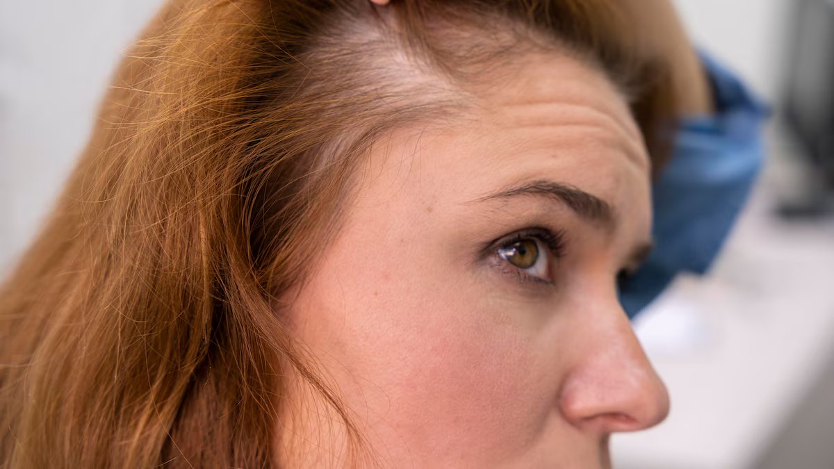 Perda de cabelo. como distinguir um processo temporário de um problema crônico