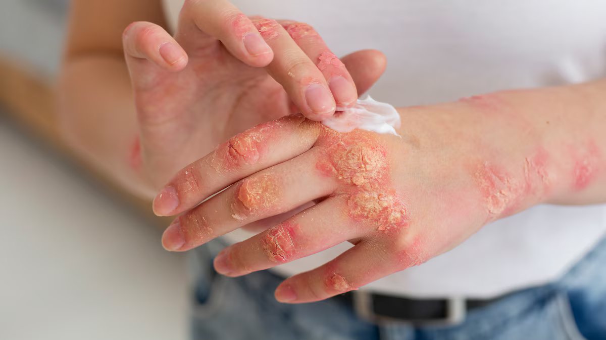 Psoríase. Em que consiste esta doença genética e por que o diagnóstico oportuno é importante?