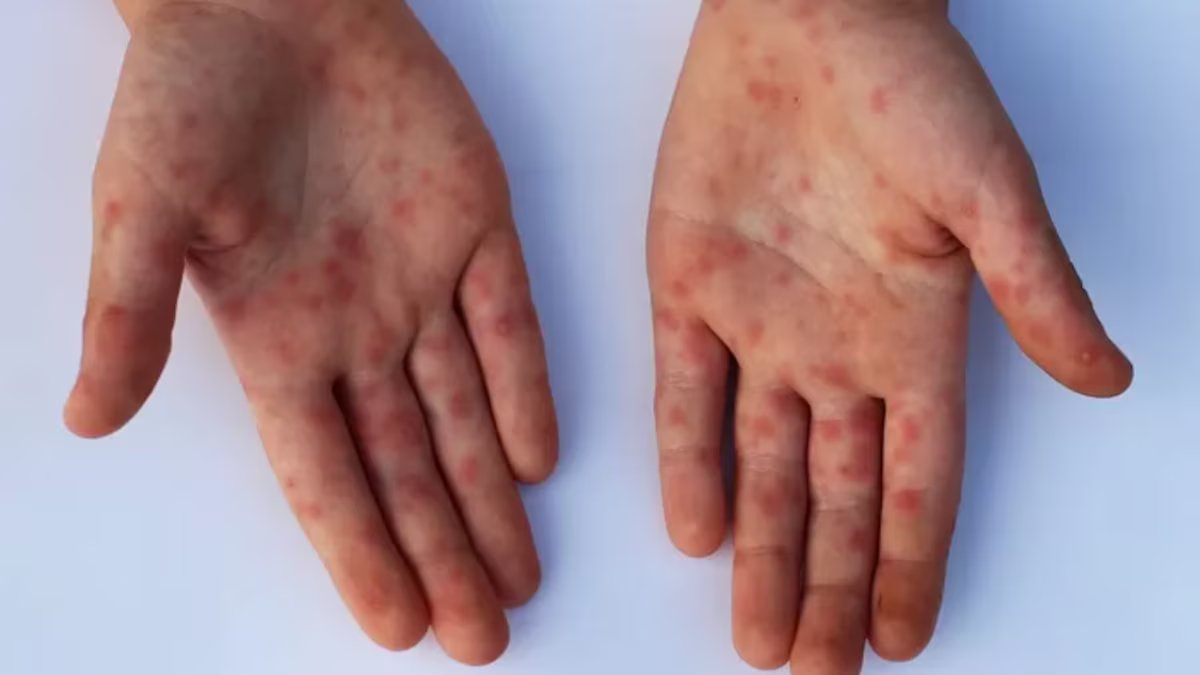 Quais são os sintomas da variante Mpox Clade Ib?