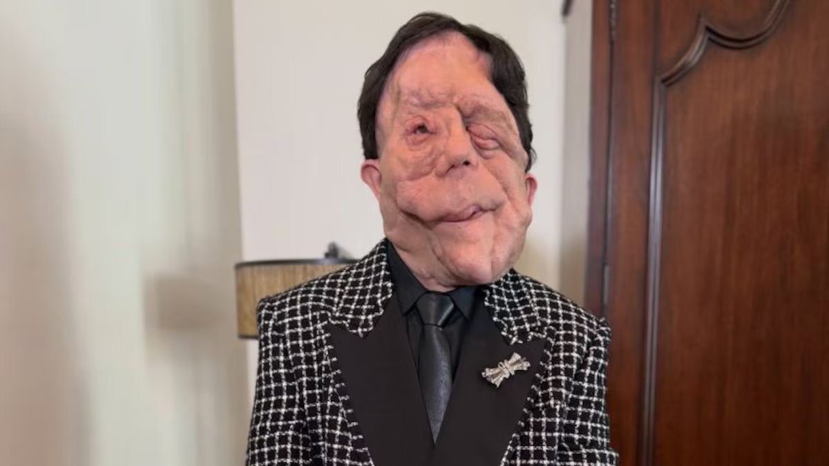 Quem é Adam Pearson, o ator com neurofibromatose que compareceu ao Oscar e deixou visível sua situação?