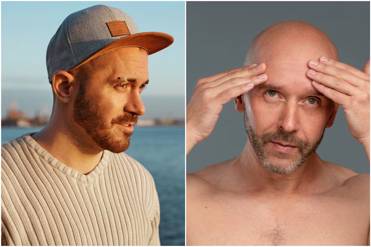 Usar boné demais está deixando você careca? Isso é o que a ciência diz