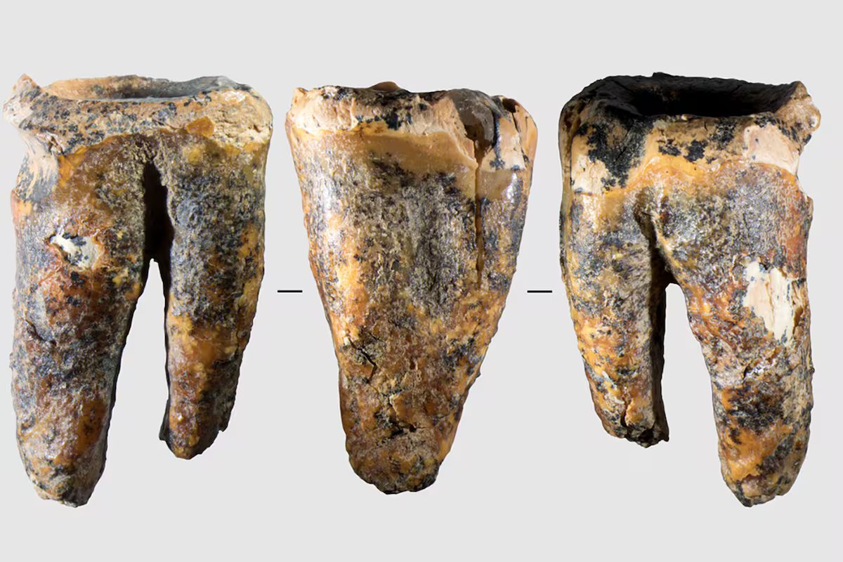 Dentistas millennials descobriram um dente de 59 mil anos tratando cáries