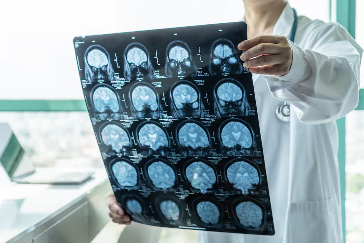 Um neurocientista detalhou a ligação entre o aumento dos níveis de glicose e o Alzheimer